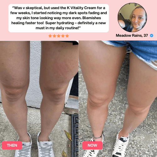 K-Vitality Cream™ (Anti-Spider Veins, Bruising & Dark Spots) (Copy)