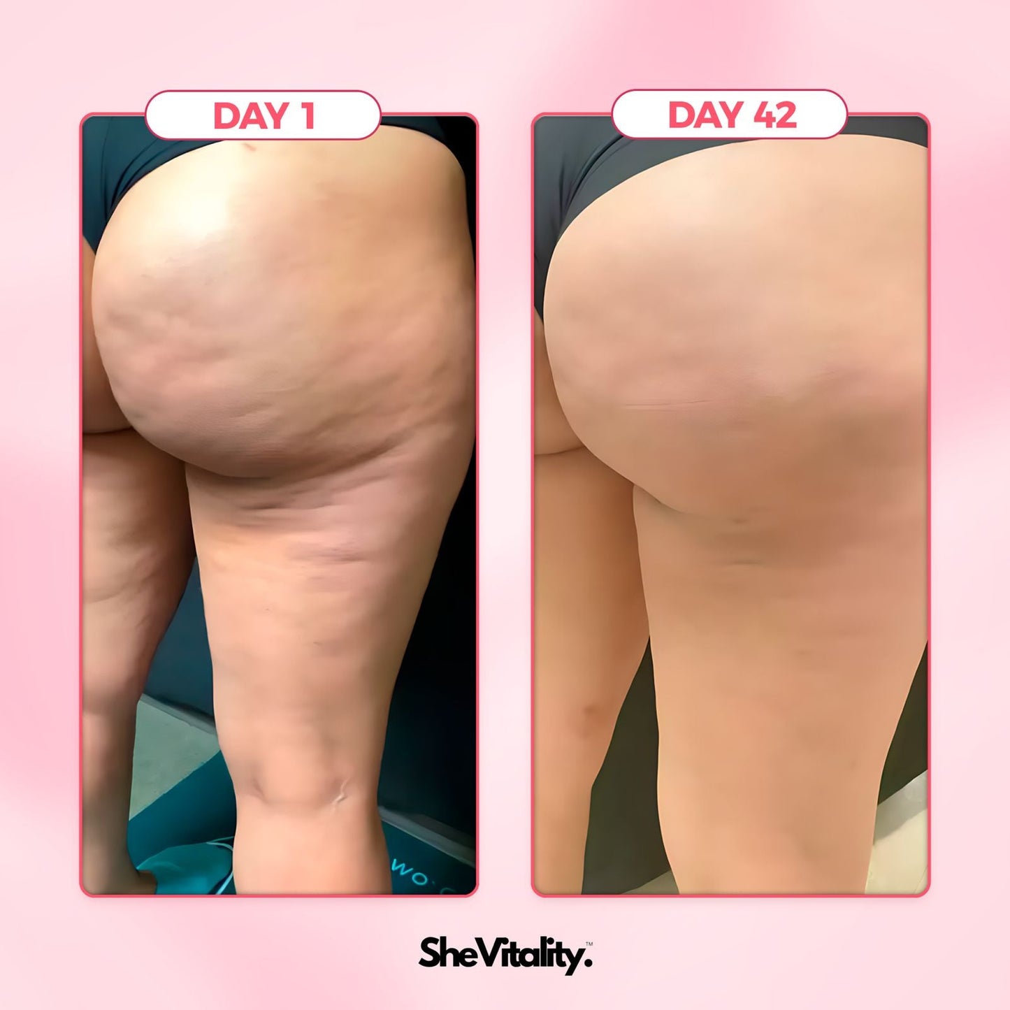 SheVitality™ Anti Cellulite Sculpting Kit