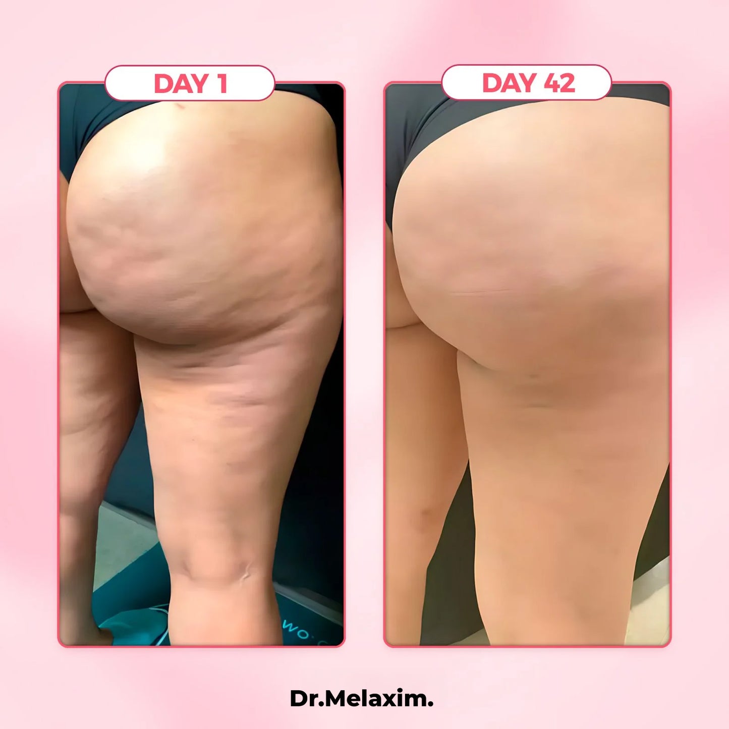 DrMelaxin™  Cellulite Relief Kit